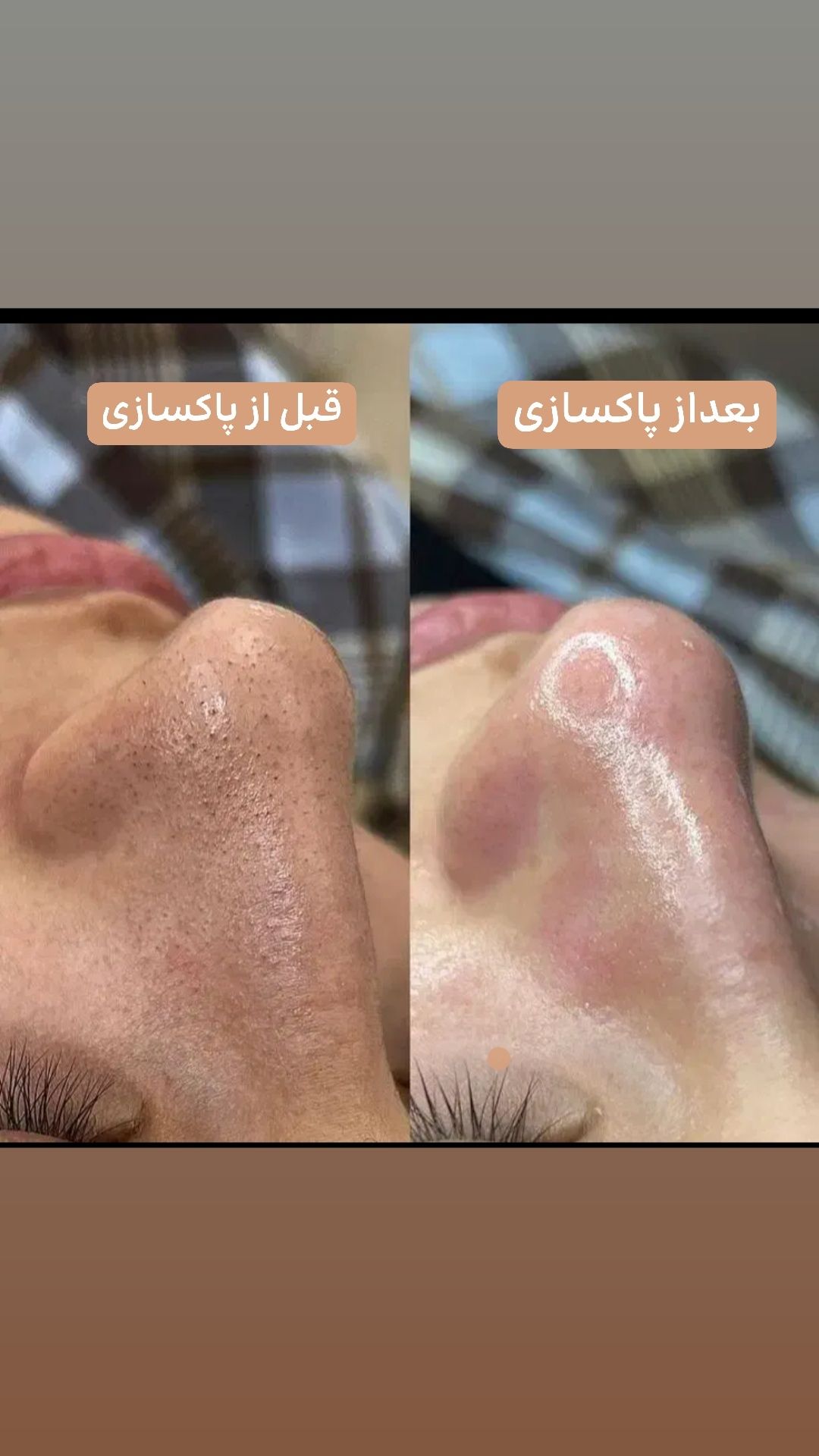 ماسک صورت کربن فعال ۳۰۰ میل کاهش قابل توجه در جوش های سرسیاه برند ویتابلا